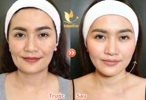 Bác sĩ căng da mặt ở Đà Nẵng được chị em tin tưởng lựa chọn nhất? 3 cang da mat toan phan 17