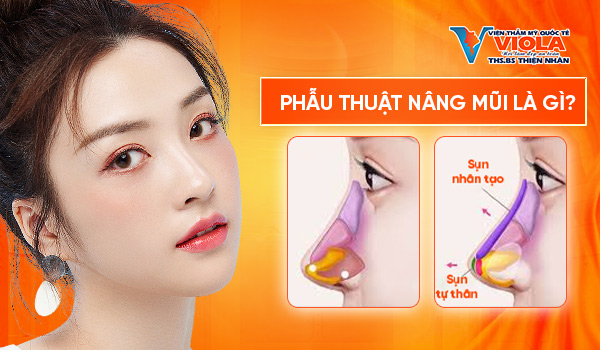 phau-thuat-nang-mui-la-gi