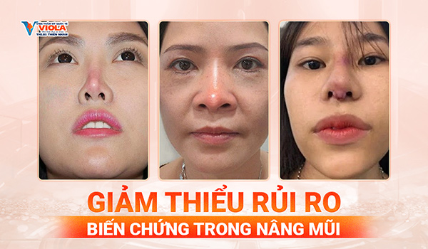 Giảm thiểu rủi ro biến chứng