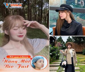 Nâng mũi Đà Nẵng cân chỉnh theo tỉ lệ gương mặt 2 cai-thien-dang-mui