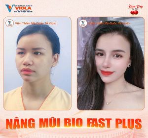 Nâng mũi Đà Nẵng cân chỉnh theo tỉ lệ gương mặt 3 ket-qua-nang-mui-bio-fast-plus