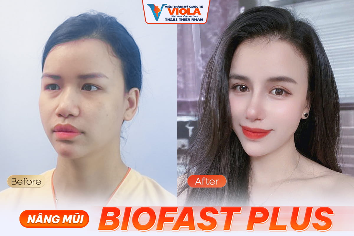 Bác sĩ nâng mũi đẹp và an toàn số 1 Đà Nẵng 3 Ket qua sau nang mui 1 8