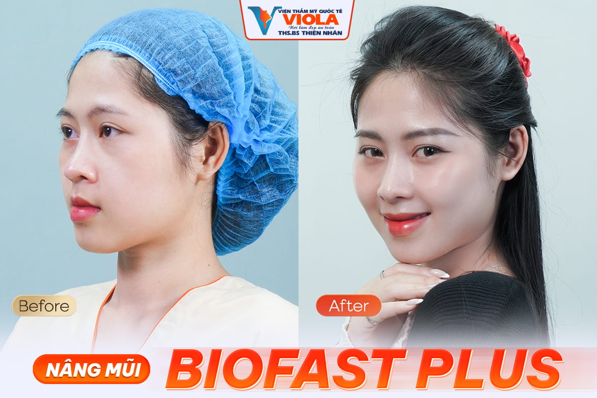 Bác sĩ nâng mũi đẹp và an toàn số 1 Đà Nẵng 2 Ket qua sau nang mui 1 9