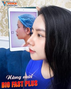 Xu hướng nâng mũi năm 2026, đẹp tự nhiên và không lộ dấu vết 4 Ket-qua-sau-nang-mui
