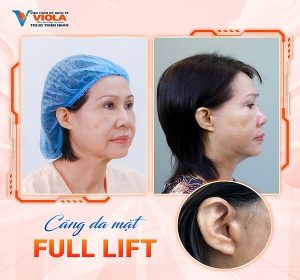 Nên căng da mặt phẫu thuật hay căng da mặt bằng chỉ tại Đà Nẵng 2 ket-qua-cang-da-mat