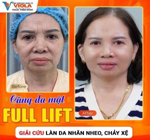 ket-qua-cang-da-mat-full-lift