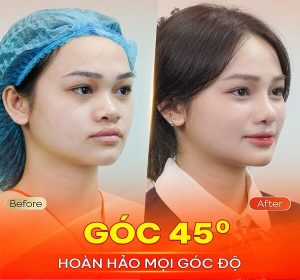 ket-qua-nang-mui-bio-fast-plus