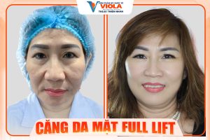 ThS.BS Thiện Nhân – Bác sĩ căng da mặt tại Đà Nẵng được khách hàng tin tưởng lựa chọn 2 cang-da-mat-da-nang