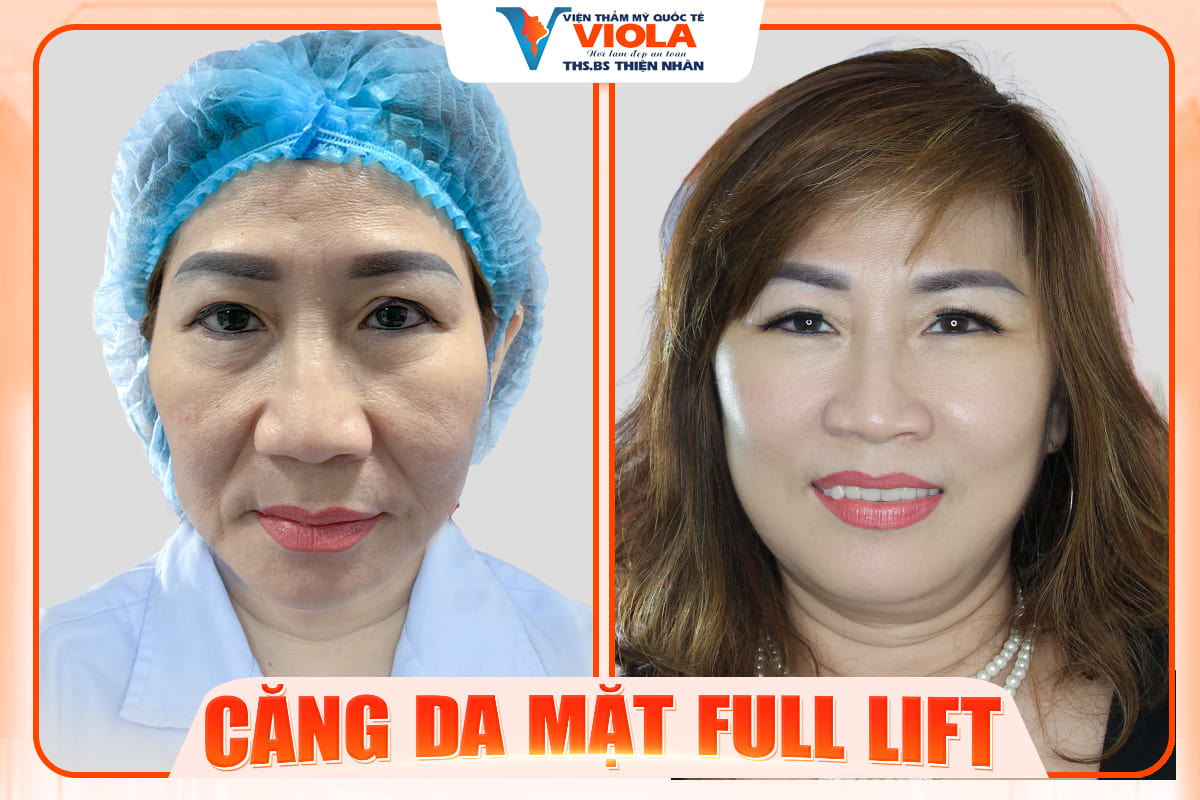 Căng da ở đâu tốt tại Đà Nẵng? Khách hàng review thực tế 4 cang da mat da nang 2 1