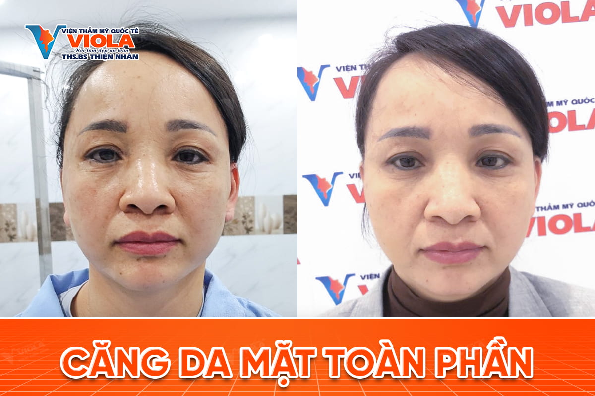 Căng Da Mặt Full Lift 4 cang da mat da nang 2 7