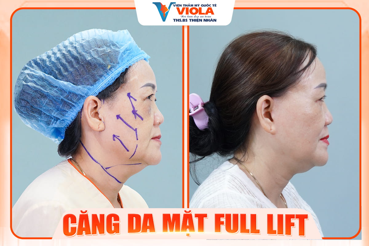 Căng da ở đâu tốt tại Đà Nẵng? Khách hàng review thực tế 3 cang da mat da nang 2