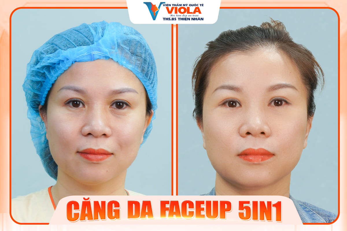 Địa chỉ căng da uy tín và an toàn nhất Đà Nẵng 2025 2 cang da faceup tai da nang