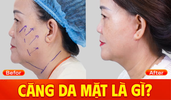 Căng da mặt Đà Nẵng - Phương pháp trẻ hóa không để lại sẹo 2 cang da mat da nang 1