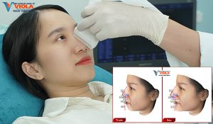 Nâng mũi Đà Nẵng ứng dụng công nghệ 4.0, dáng mũi chuẩn millimet 5 ung-dung-cong-nghe-ultra-beauty-va-he-thong-phan-tich-3d-doc-quyen