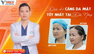 Làm đẹp an toàn với địa chỉ căng da mặt Đà Nẵng uy tín, chuyên nghiệp 3 dia-chi-cang-da-mat-tot-nhat-tai-da-nang-tham-my-vien-viola