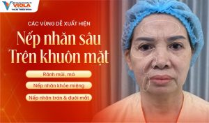cac vung de xuat hien nep nhan sau tren khuon mat