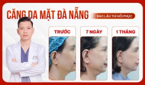 Căng da mặt Đà Nẵng giúp nâng cơ, trẻ hóa làn da 4 cang-da-mat-da-nang-bao-lau-thi-hoi-phuc