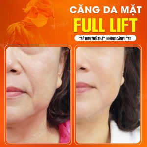 Địa chỉ căng da mặt Đà Nẵng ứng dụng kỹ thuật nâng cơ đa lớp 4 phau thuat cang da da nang 2 18