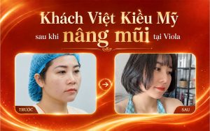 Vì sao nhiều khách hàng từ xa vẫn chọn nâng mũi Đà Nẵng? 3 khach-viet-kieu-ky-sau-khi-nang-mui-tai-viola