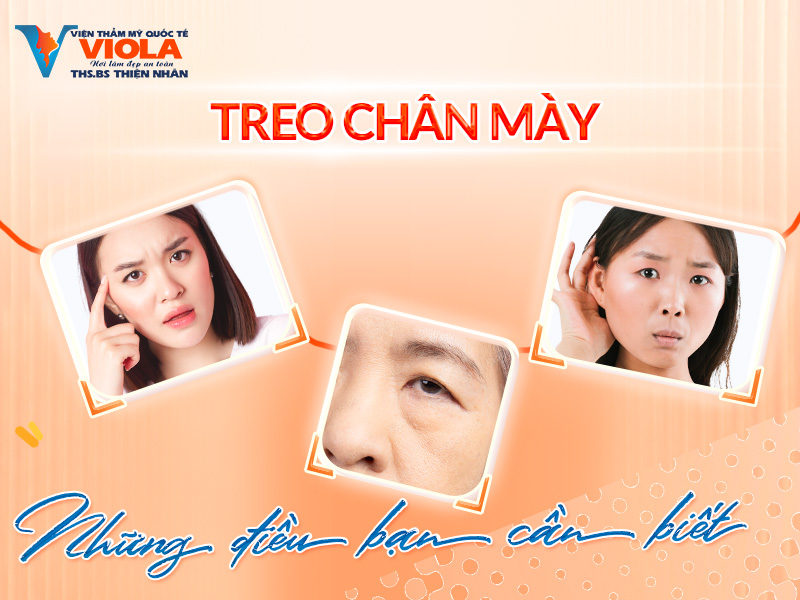 1 treo chan may