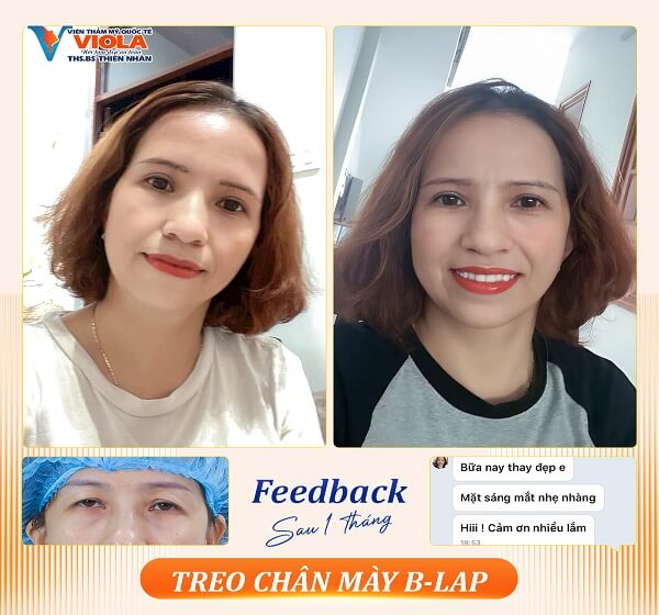 KẾT QUẢ TREO CHÂN MÀY 5 ket qua treo chan may 4