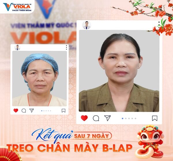 KẾT QUẢ TREO CHÂN MÀY 6 ket qua treo chan may 5