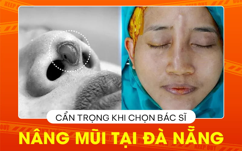 can trong khi chon bac si nang mui tai da nang