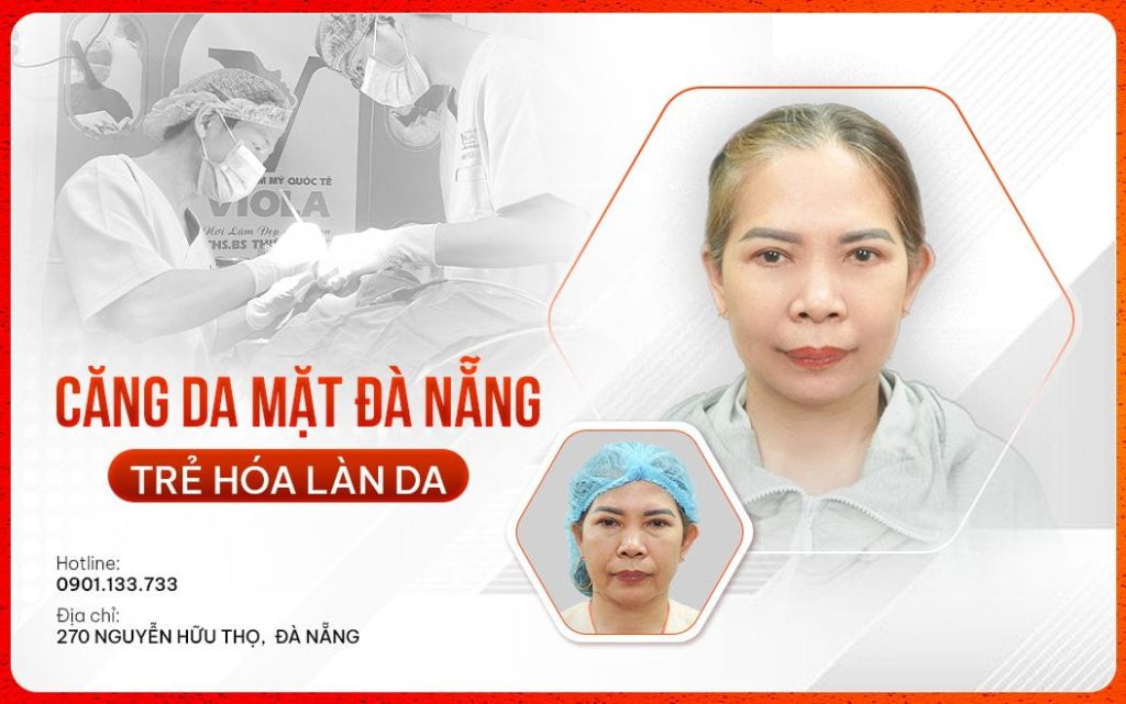 Căng da mặt Đà Nẵng giúp nâng cơ, trẻ hóa làn da 1 cang da mat da dang giup nang co tre hoa lan da