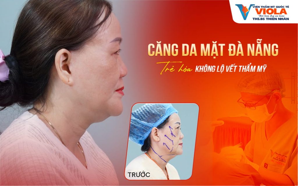 Căng da mặt Đà Nẵng trẻ hóa không lộ dấu vết thẩm mỹ 1 cang da mat da nang tre hoa khong lo dau vet tham my