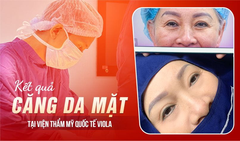 Sai lầm khi chọn bác sĩ căng da mặt ở Đà Nẵng khiến nhiều chị em hối hận không kịp 2 ket-qua-cang-da-mat-tai-Viola