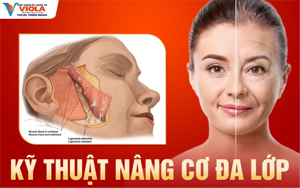 Địa chỉ căng da mặt Đà Nẵng ứng dụng kỹ thuật nâng cơ đa lớp 1 ky thuat nang co da lop