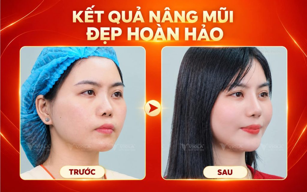 ket-qua-nang-mui-dep-hoan-hao